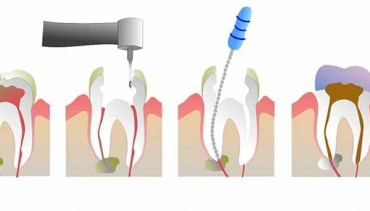 Root Canal Therapy