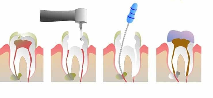 Root Canal Therapy