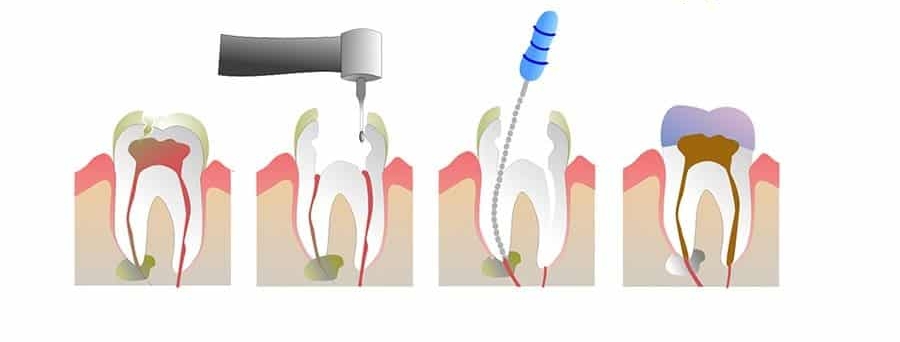 Root Canal Therapy